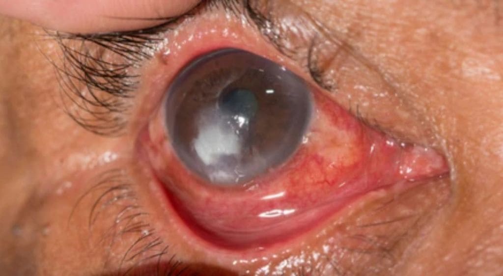 Viêm loét giác mạc là nguyên nhân phổ biến gây sẹo