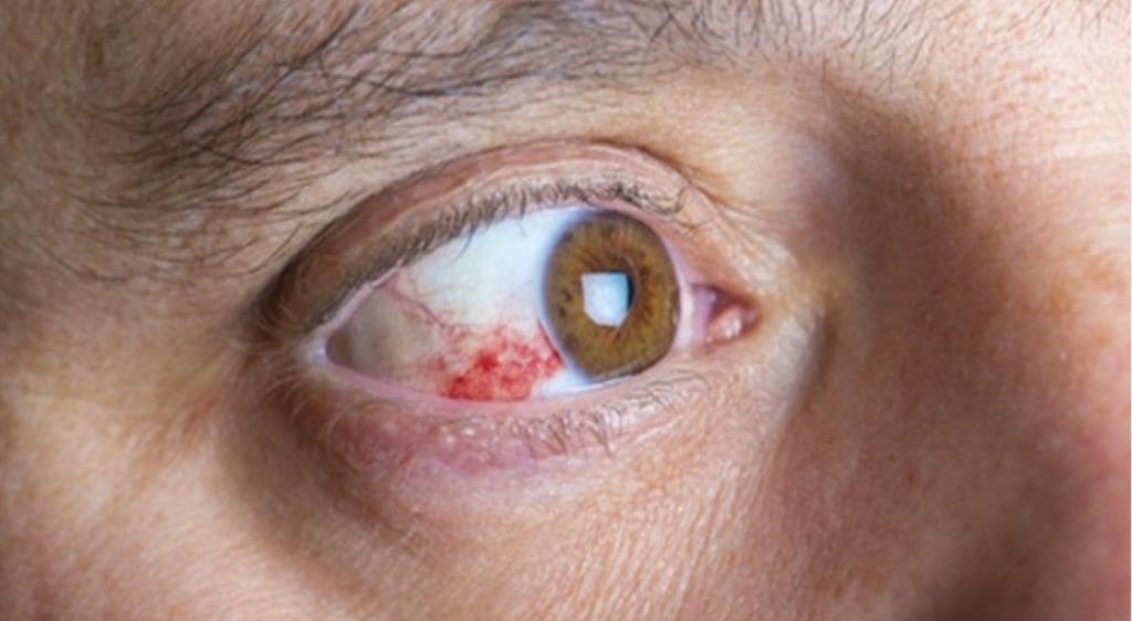 Xước giác mạc là loại tổn thương phổ biến nhất ở giác mạc