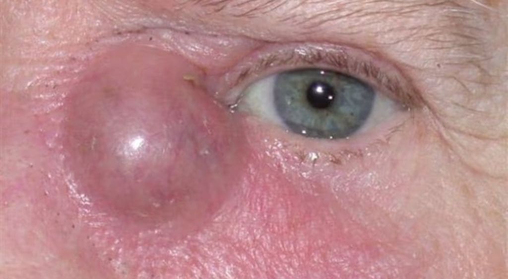 Áp xe tuyến lệ là tình trạng nhiễm trùng nặng, dẫn đến hình thành ổ viêm tại vùng mắt