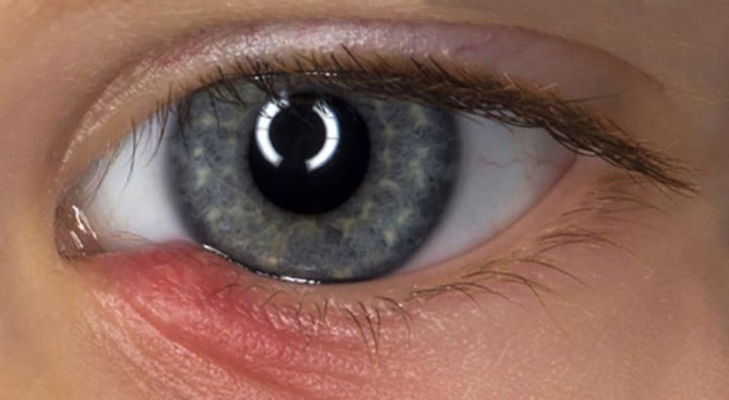 Biến chứng mắt sưng nề sau khi phẫu thuật mổ tuyến lệ