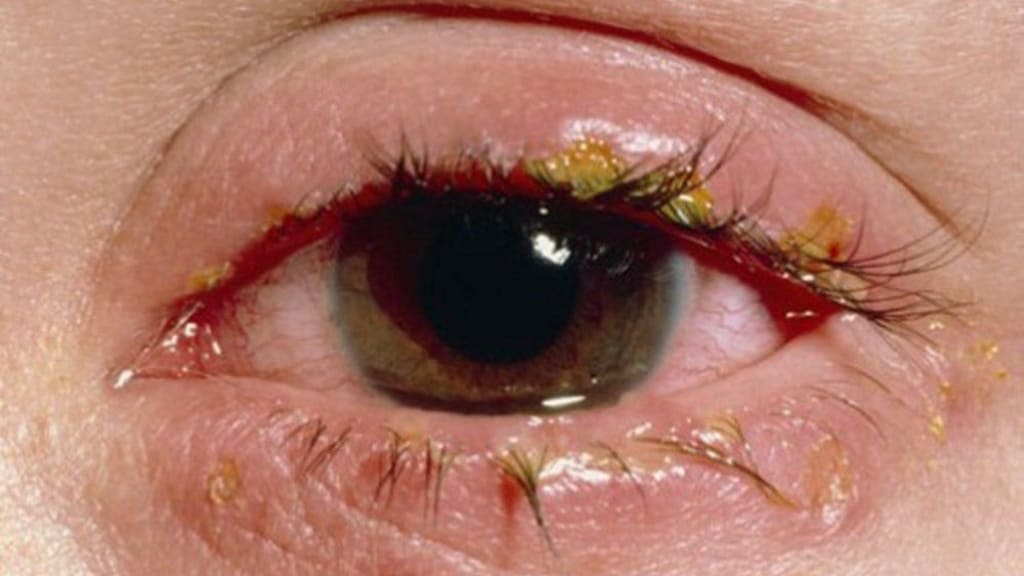 Cần đi khám bác sĩ ngay nếu mắt xuất hiện nhiều ghèn bất thường