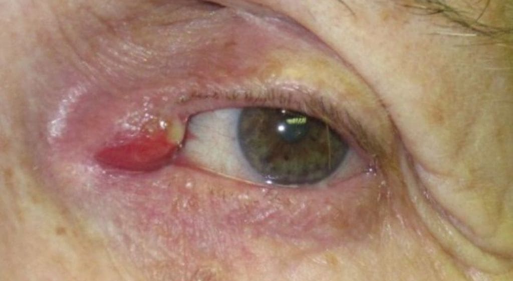 Cần thông tuyến lệ ngay khi mắt có dấu hiệu sưng viêm và tiết dịch mủ