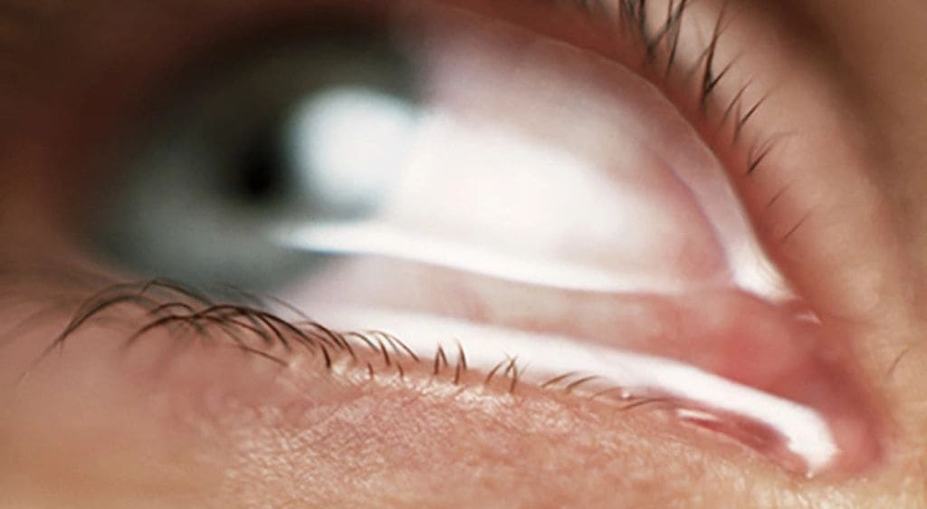 Chảy nước mắt phản xạ là một nghịch lý thường gặp khi bị khô tuyến lệ
