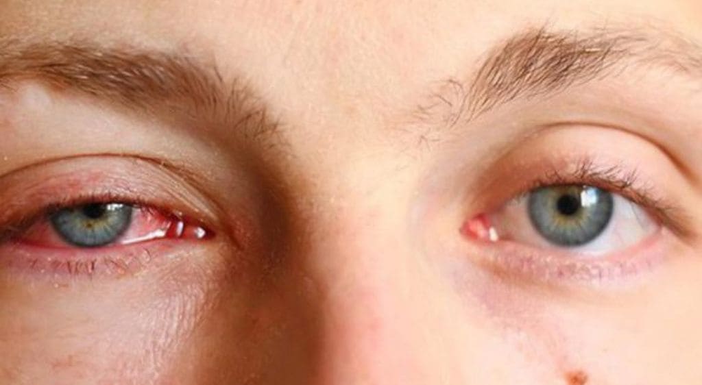 Dấu hiệu viêm tuyến lệ cần được điều trị sớm gồm: sưng, đau vùng đuôi mắt, chảy nước mắt