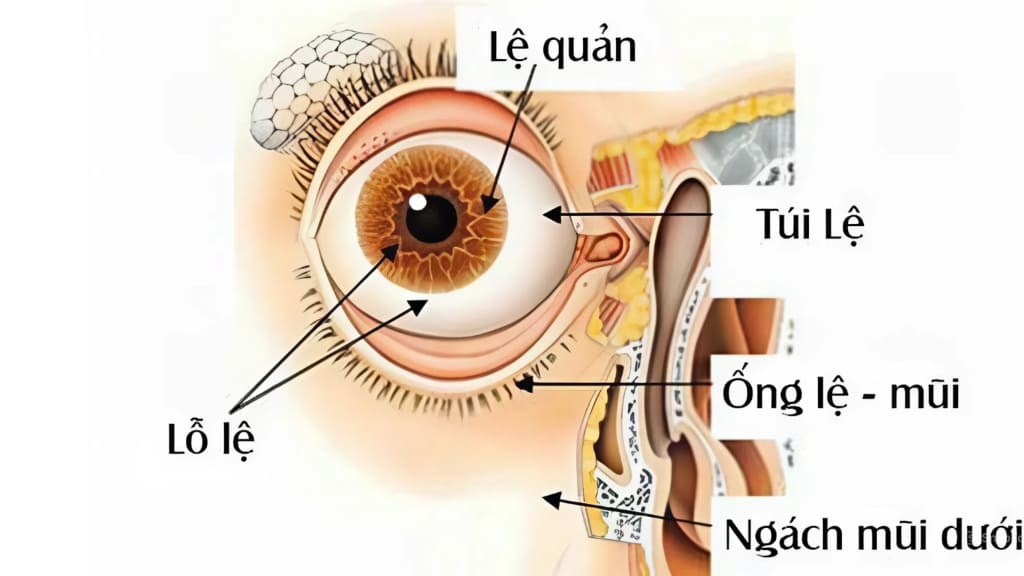 Đường mổ tuyến lệ thường được tiếp cận từ hốc mắt trên - ngoài