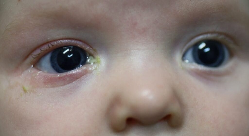 Lỗ rò túi lệ gây tiết dịch mủ