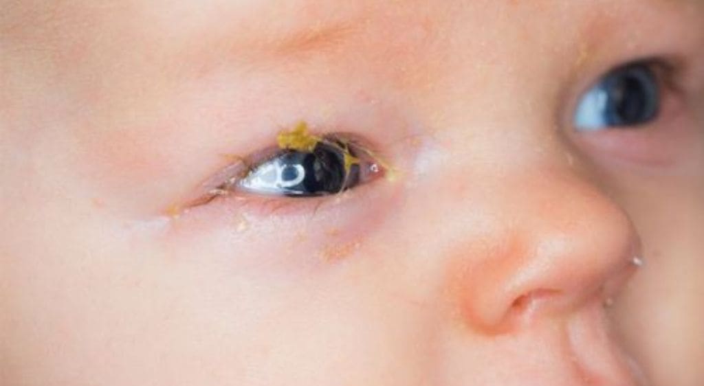 Mắt bé bị đổ ghèn liên tục là thời điểm cần thực hiện mát xa thông tuyến lệ