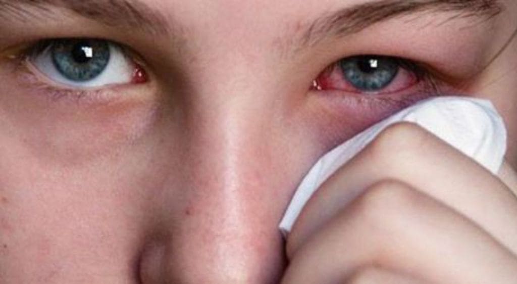 Mắt đau nhức, sưng nề là triệu chứng phổ biến khi bị lỗ rò túi lệ