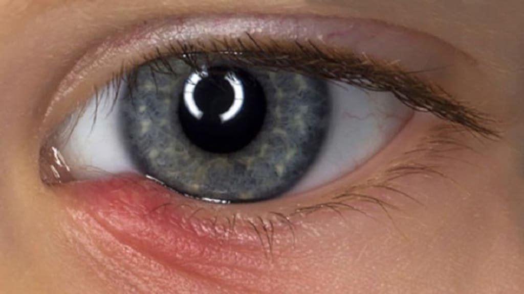 Ngứa tuyến lệ có thể dẫn tới áp xe túi lệ nghiêm trọng