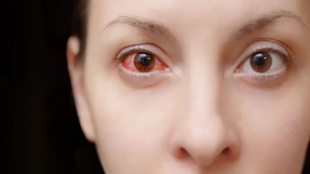 Nhiễm trùng mắt kéo dài là một trong những nguyên nhân chính hình thành nang tuyến lệ