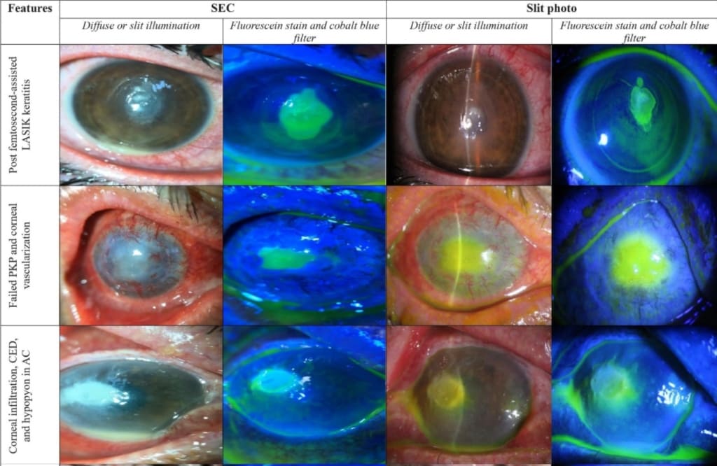 Nhuộm giác mạc là phương pháp phổ thông để đánh giá tổn thương bên trong