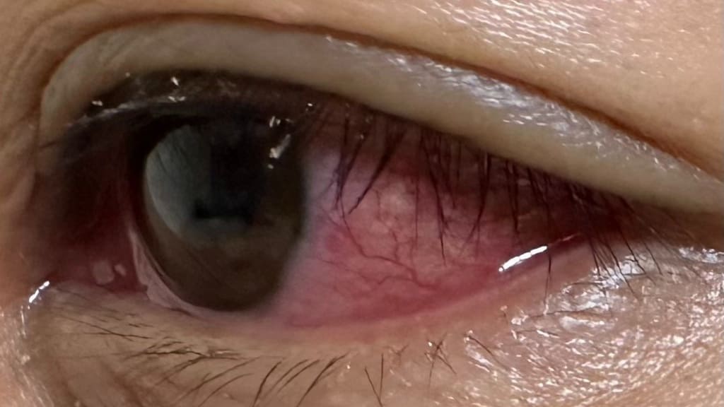 Phẫu thuật cắt tuyến lệ chống chỉ định với bệnh viêm kết mạc