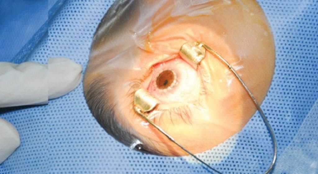 Phẫu thuật ghép giác mạc giúp phục hồi thị lực