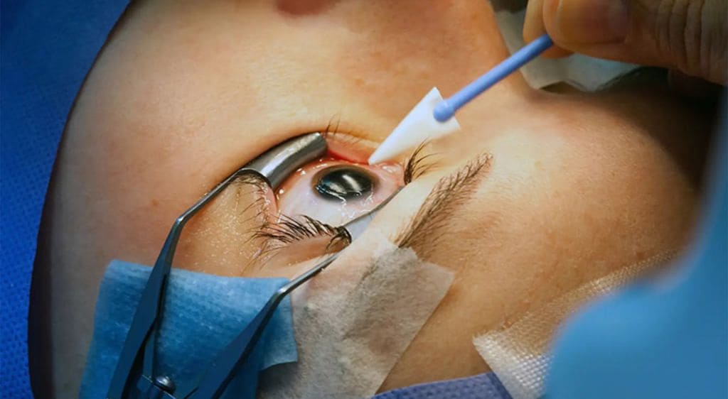 Phẫu thuật tắc tuyến lệ ít xâm lấn, tỷ lệ thành công cao