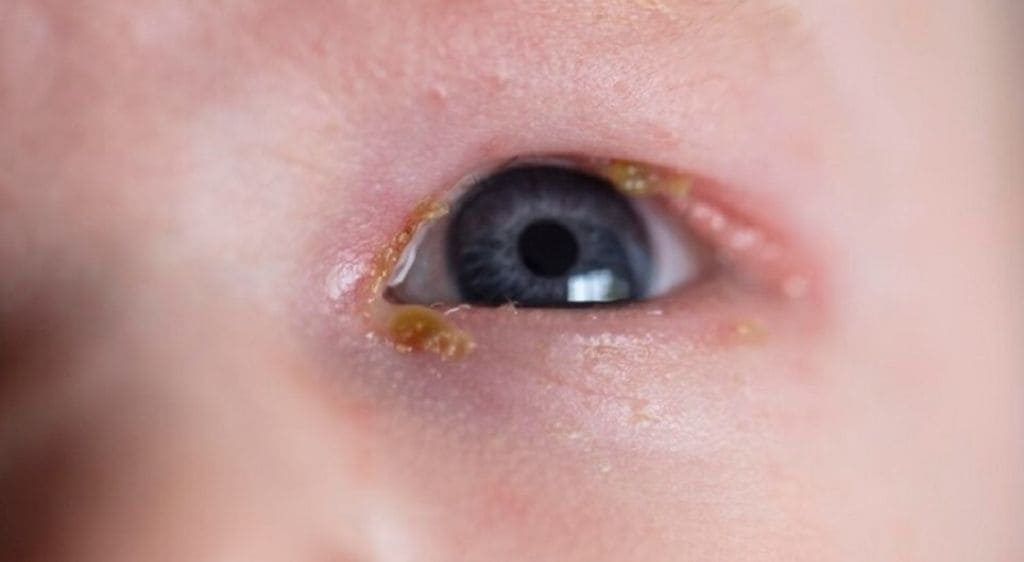 Tắc tuyến lệ ở trẻ sơ sinh khiến bé bị chảy nước mắt sống và đổ ghèn liên tục