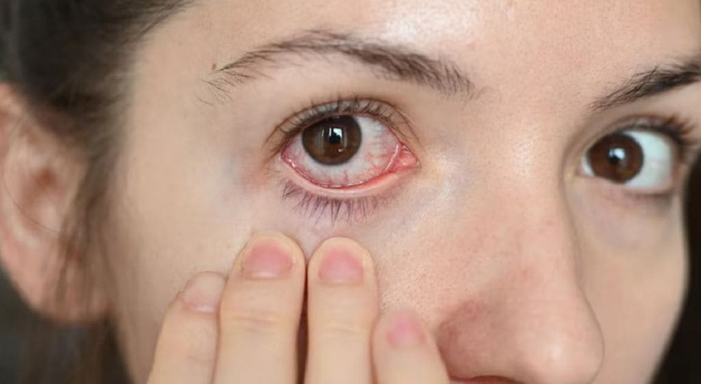 Thông tuyến lệ kịp thời giúp chấm dứt tình trạng mắt sưng đỏ, đau nhức