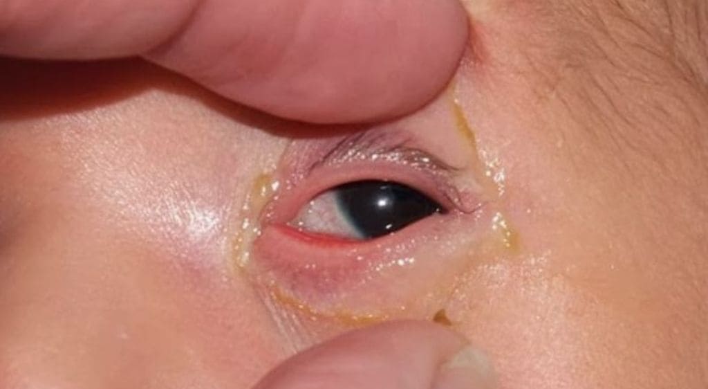 Thuốc nhỏ mắt chứa kháng sinh loại bỏ tình trạng mắt có mủ và ghèn đặc