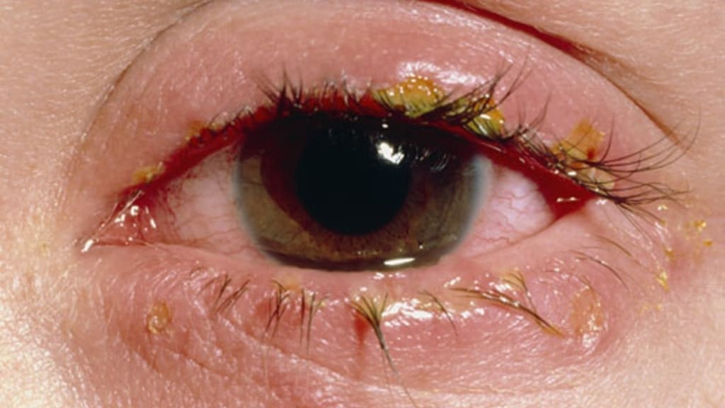 Tình trạng mắt ngấn nước, long lanh thường xuyên do tiết dịch quá mức là dấu hiệu nhận biết chứng rối loạn tuyến lệ