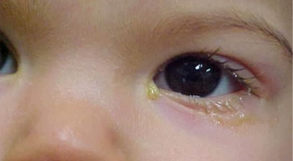 Viêm tuyến lệ gây sưng đỏ, đau nhức ở phần ngoài mi trên có thể kèm sốt và nổi hạch