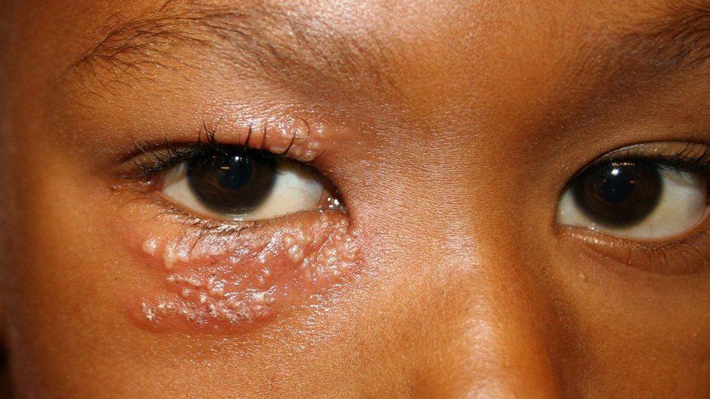 Zona thần kinh ở mắt có thể dẫn tới giảm thị lực và mù lòa