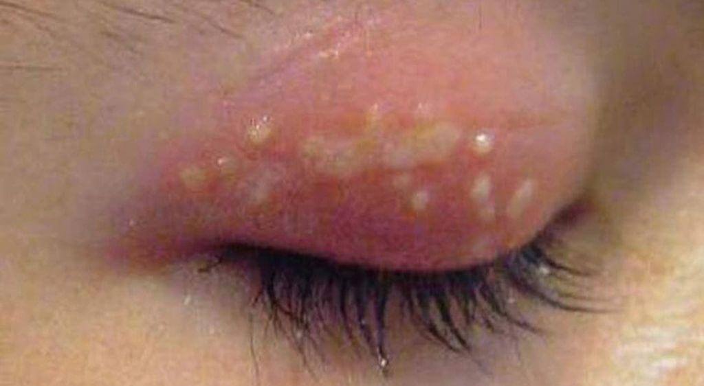 Zona thần kinh ở mắt nguy hiểm hơn nhiều so với zona ở các vị trí khác trên cơ thể