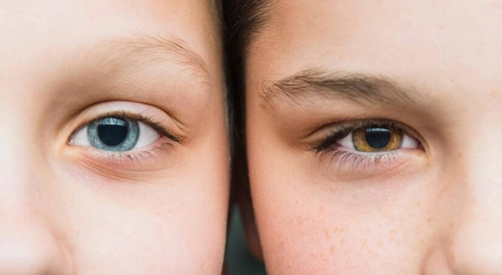 Bẩm sinh (di truyền) là nguyên nhân phổ biến nhất gây ra tình trạng mắt 2 màu