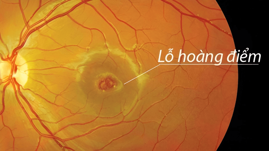 Lỗ hoàng điểm là một lỗ nhỏ xuất hiện ở trung tâm điểm vàng