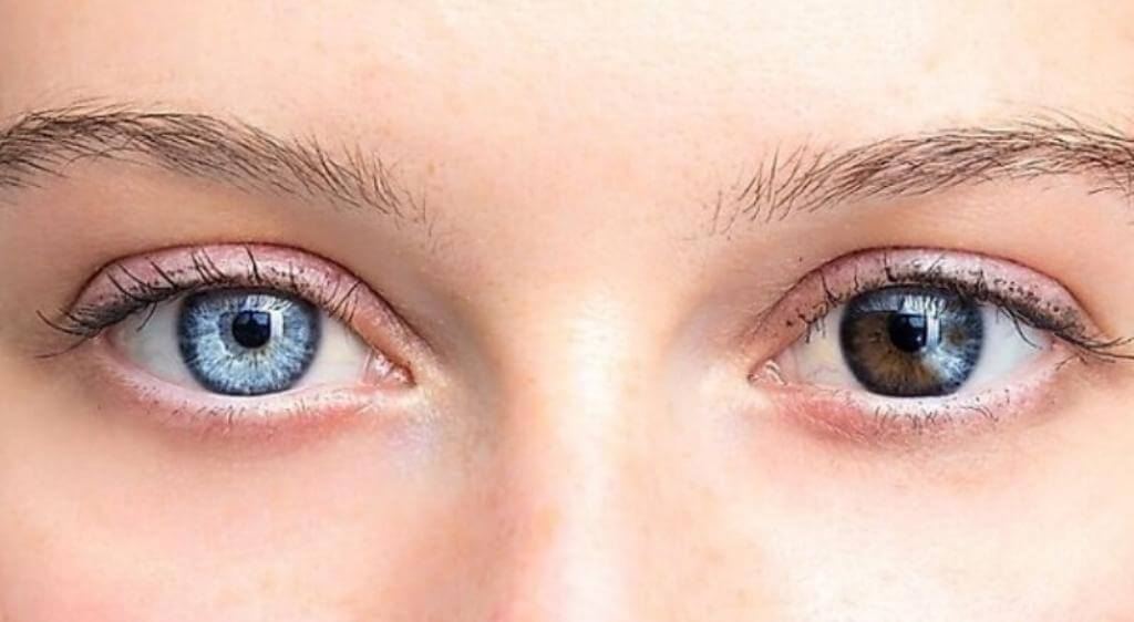 Mắt 2 màu là hiện tượng hai mắt có màu sắc khác nhau do rối loạn sắc tố Melanin
