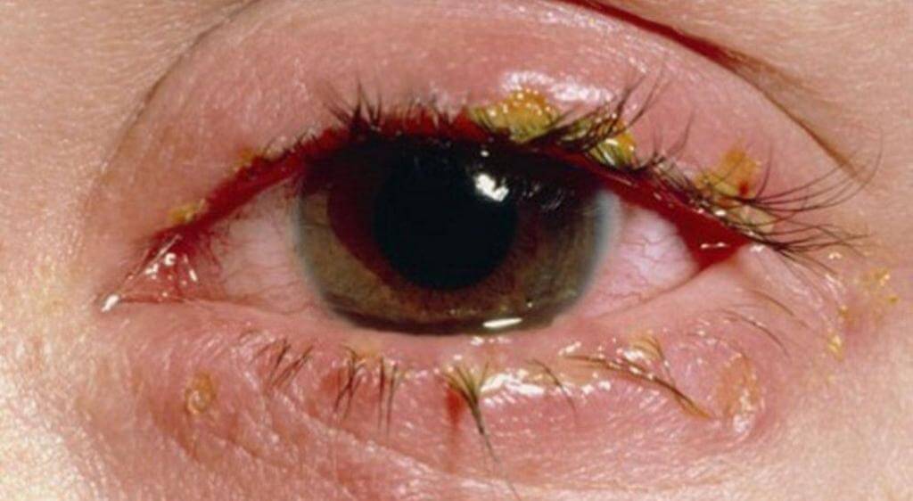 Mắt đổ ghèn nhiều khi ngủ dậy thường do nhiều nguyên nhân khác nhau