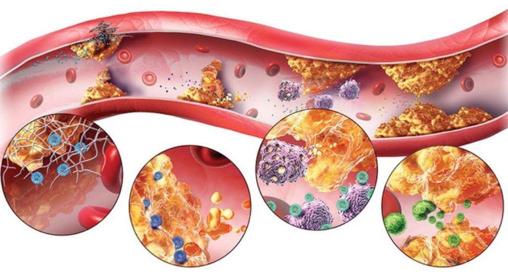 Rối loạn chuyển hóa lipid máu là nguyên nhân phổ biến nhất gây u vàng mi mắt