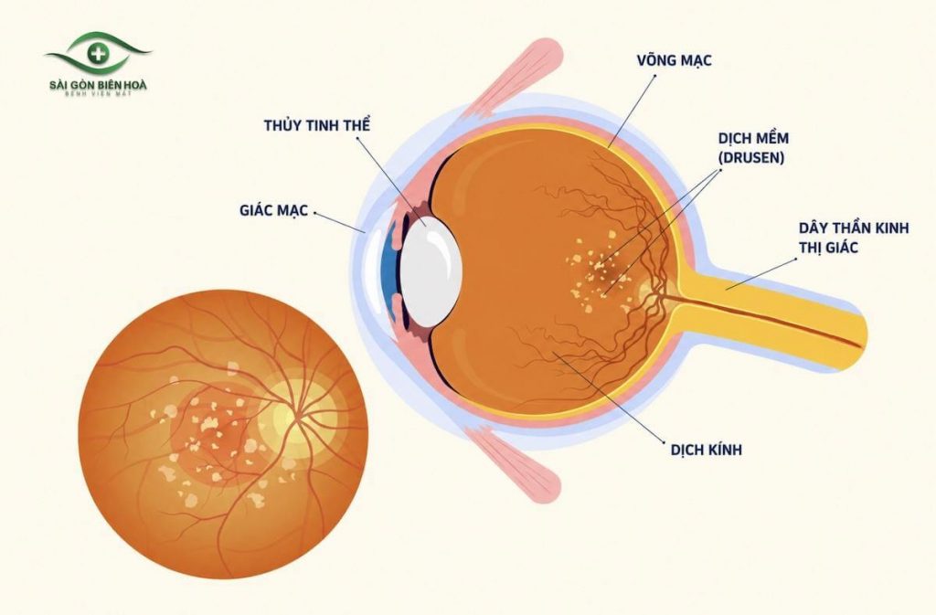 Thoái hóa điểm vàng thể khổ khiến điểm vàng bị mỏng đi và xuất hiện các mảnh vụn màu vàng