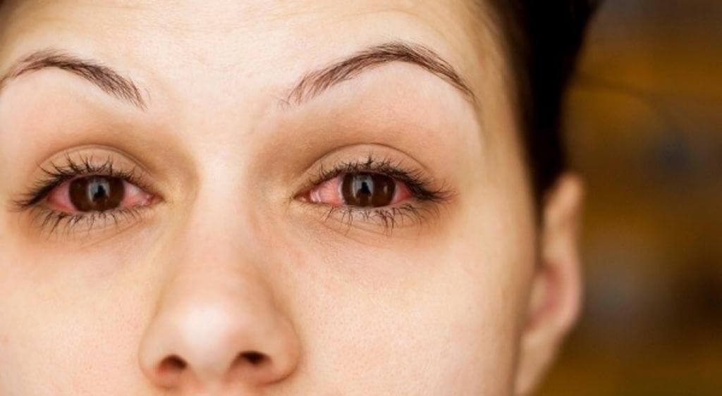 Tình trạng khô mắt gây chảy nước mắt sống ở bà bầu xảy ra do phản xạ bù trừ