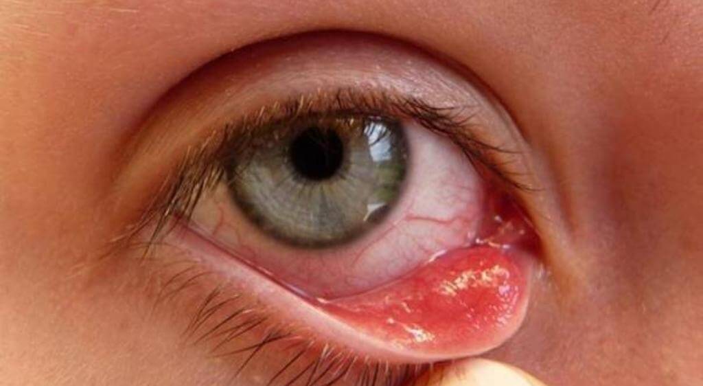 Viêm bờ mi khiến người bệnh thức dậy với ghèn có màu vàng hoặc xanh đặc