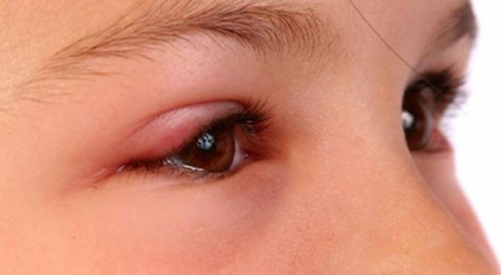 Da mí mắt mỏng, nhiều mạch máu nên rất dễ sưng phù khi bị côn trùng cắn