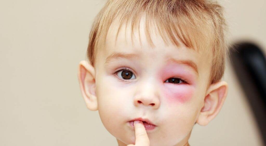 Nọc độc côn trùng kích hoạt phản ứng dị ứng, làm histamine tăng cao và gây sưng mí mắt đột ngột