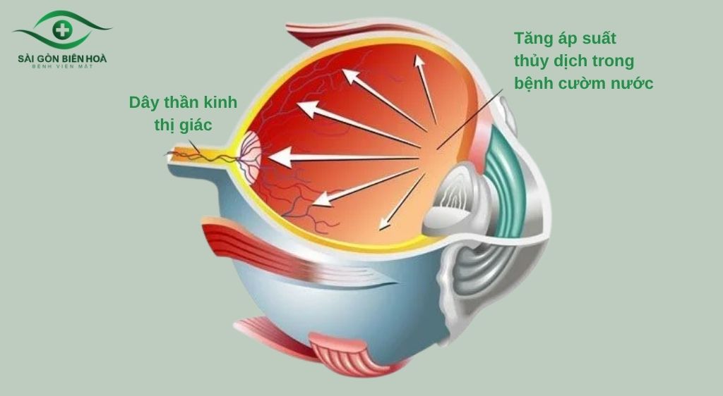 Bệnh cườm nước