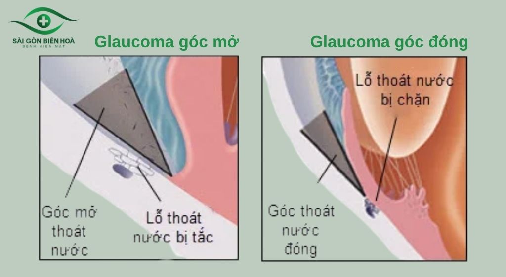 Bệnh Glaucoma