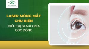 Laser mống mắt chu biên