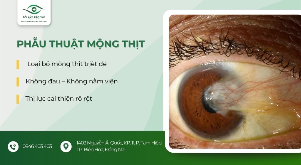 phẫu thuật mộng thịt