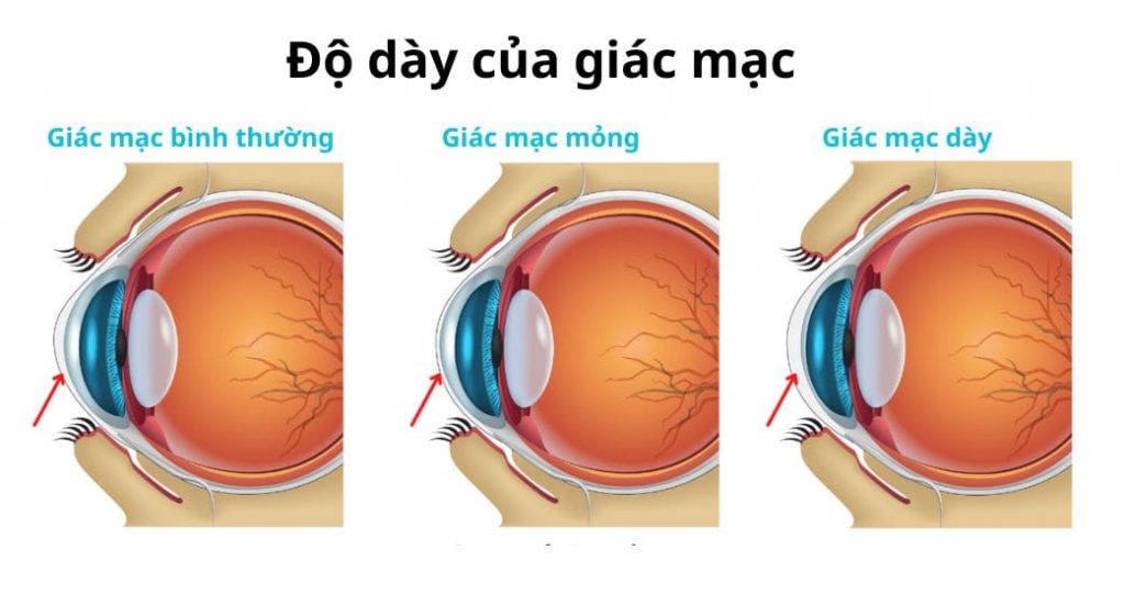 Độ dày của giác mạc