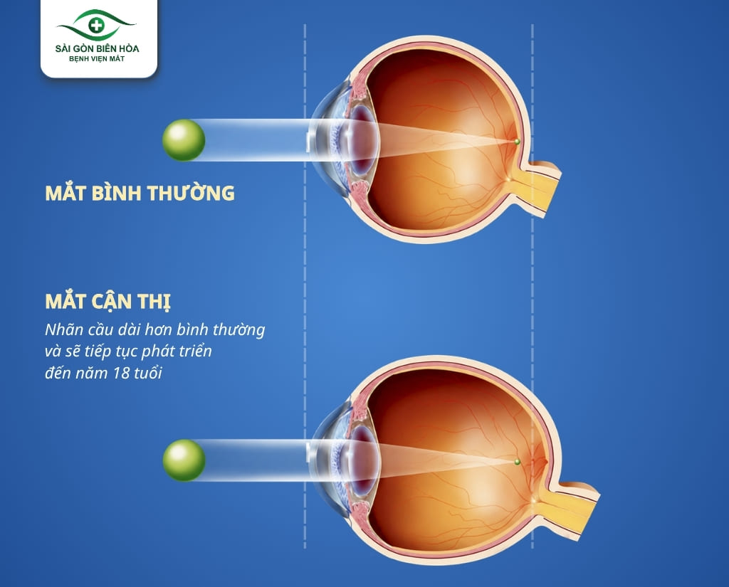 Chiều dài nhãn cầu sẽ tiếp tục phát triển, dài ra cho đến 18 tuổi