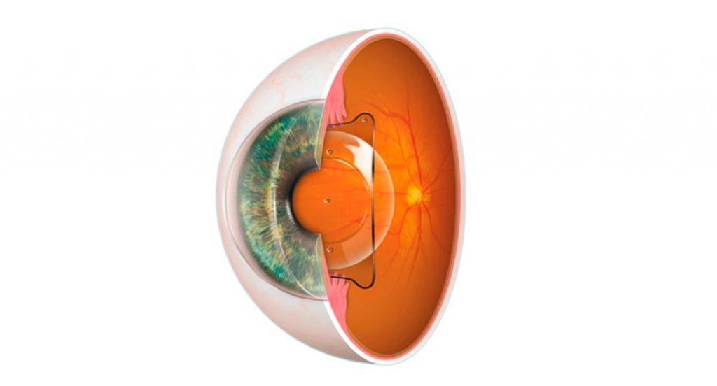 Vị trí thấu kính trong phẫu thuật Phakic