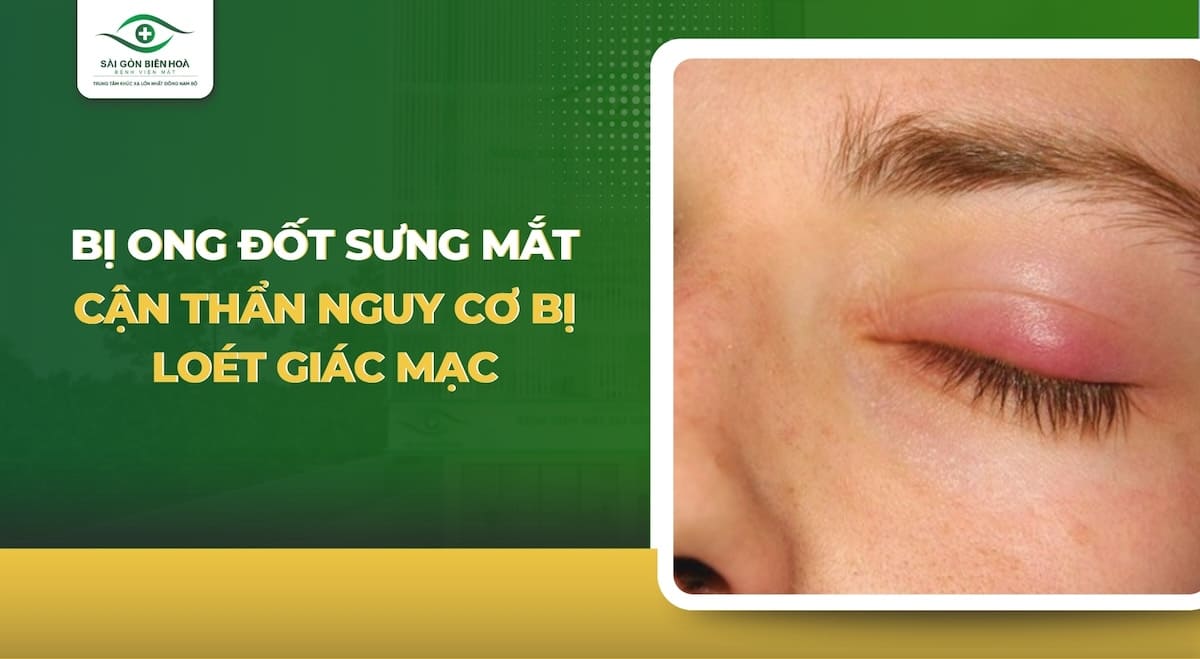 Bị ong đốt sưng mắt