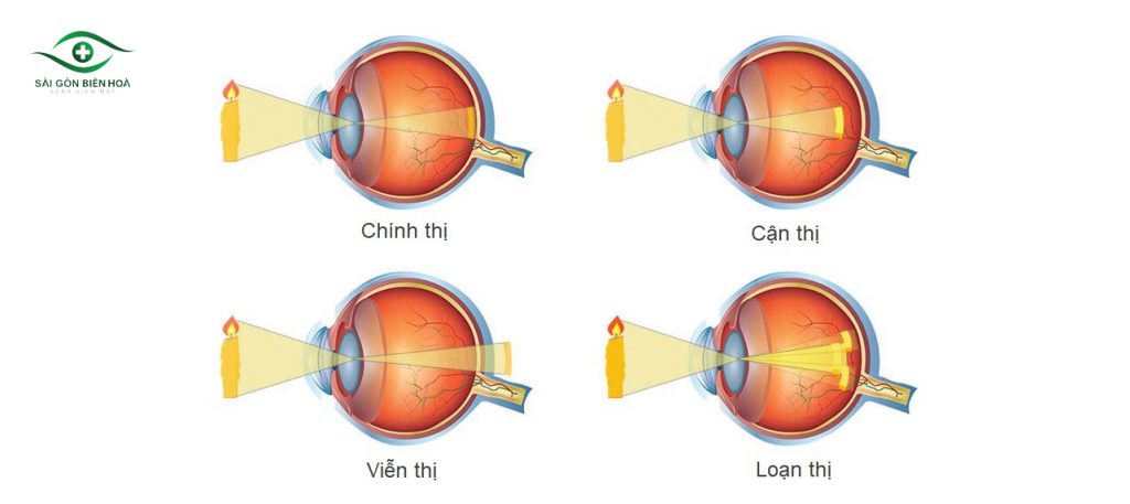 Các tật khúc xạ