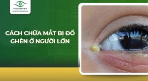 Cách chữa mắt bị đổ ghèn ở người lớn