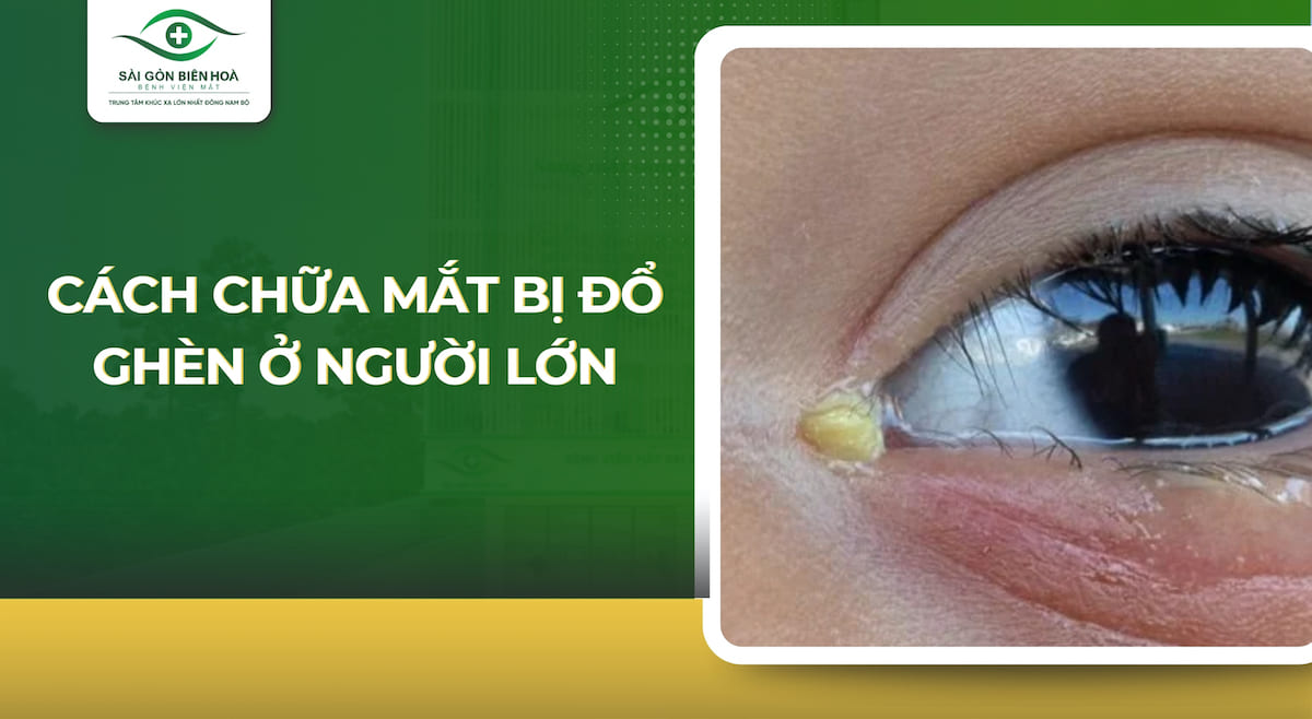Cách chữa mắt bị đổ ghèn ở người lớn