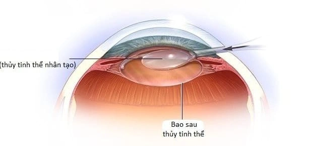 Giảm thị lực do đục bao sau