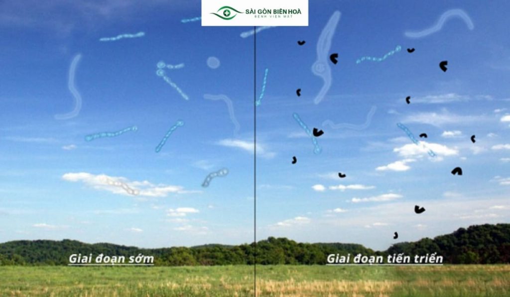 Hình ảnh minh họa dấu hiệu ruồi bay trước mắt