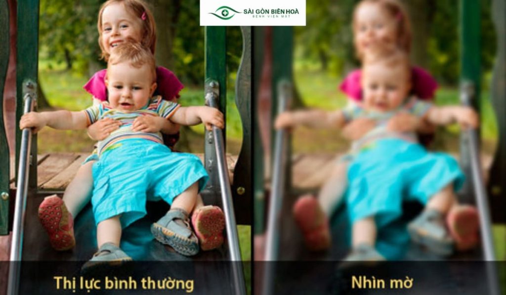 Người bị đục thủy tinh thể sẽ thường gặp tình trạng mờ mắt như có sương che trước mắt khó nhìn và hay bị mỏi mắt khi nhìn quá lâu