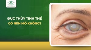 Đục thủy tinh thể có nên mổ không? Khi nào được phẫu thuật?